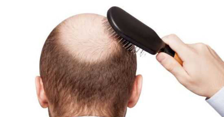 با دلایل پنهان ریزش موها آشنا شوید